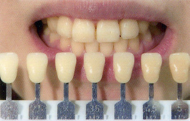 ホワイトニング前の色調を確認し、どこまで白くできるか、目標を確認します。