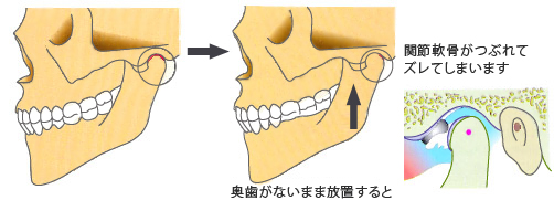 かみ合わせと食いしばりの影響