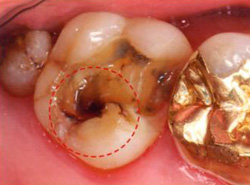 詰めものをはずしてみるとこんなにむし歯がひろがっていました